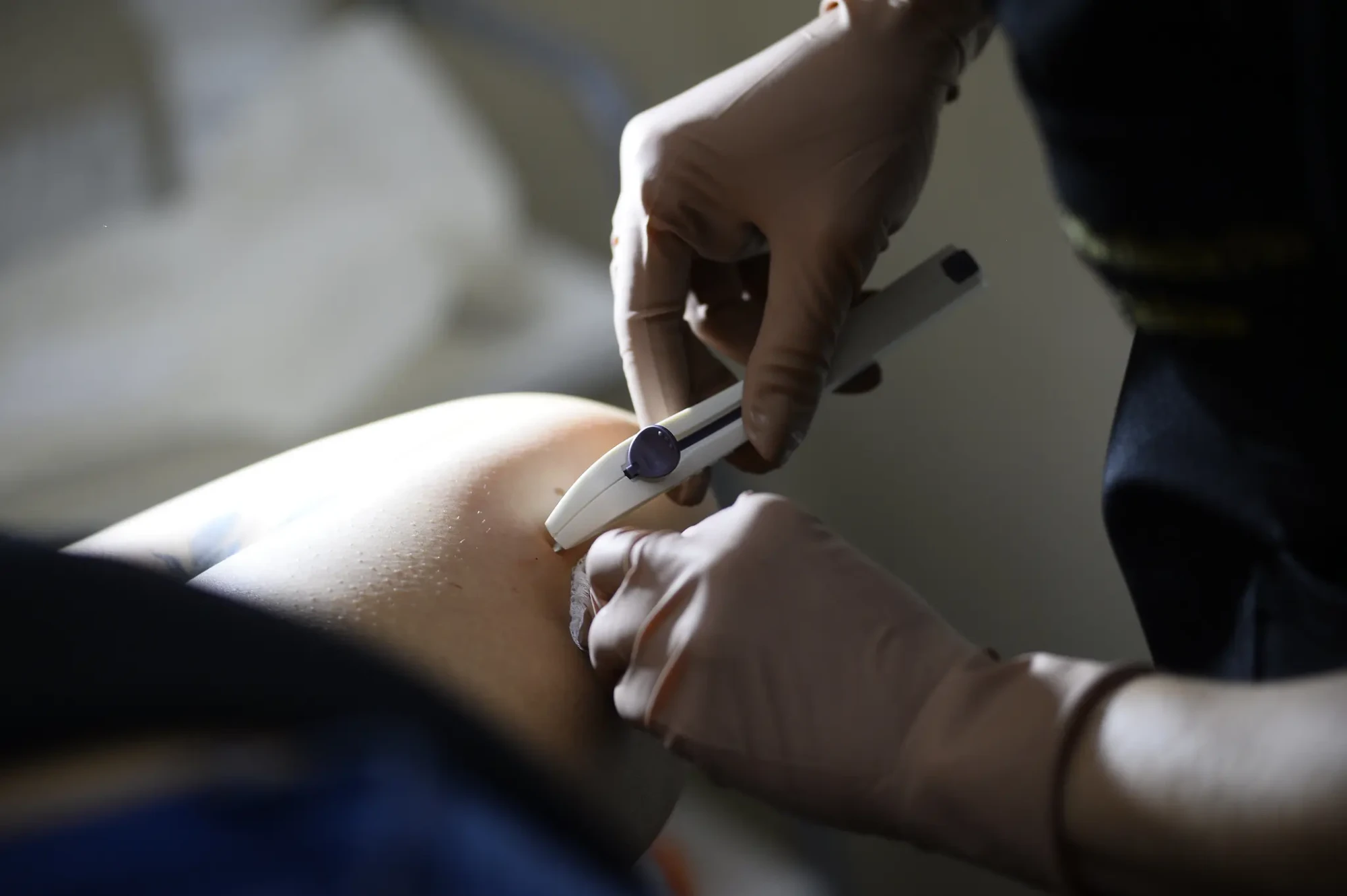 07022026 - Implanon na Atenção Primária - Fotos Matheus Oliveira Agência Saúde DF (1)